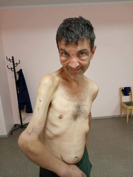     Його фото облетіло весь світ: захисник Азовсталі повернувся з полону РФ без кістки в руці    